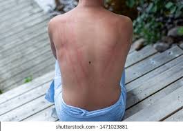 Image result for Dermatographism