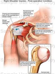 But i have to say that you putted in the picture the teres major and its important to clarify that it isnt one of the 4 rotator cuff muscles, the fourth is. Right Shoulder Anatomy Anatomy Drawing Diagram