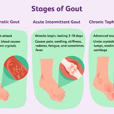 Gout is a form of arthritis that occurs when abnormally high levels of uric acid build up in the body, causing crystals to form in joints. Hyperuricemia And Kidney Disease