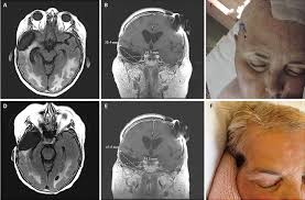 sinking skin flap syndrome in