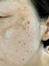 シミだらけの40代女性の顔の肌のクローズアップの写真・画像素材[5760185]-Snapmart（スナップマート） さん