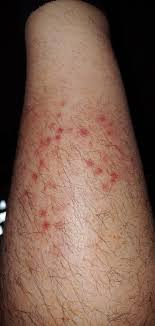 It can appear anywhere, in any pattern and shapes. Help Non Itchy Rash On Lower Shin Feels Bruised Feels Swollen What Is This Doctorsadvice
