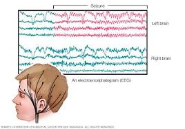 Eeg Electroencephalogram Mayo Clinic Brain Activities Temporal Lobe Epilepsy Left Brain Right Brain