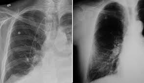 Mesothelioma is a rare form of cancer that affects the cells that make up the mesothelium. Mesothelioma Misdiagnosis The Importance Of A Second Opinion