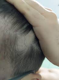 Maybe you would like to learn more about one of these? Hair Won T Grow In This One Spot Do You Know The Cause Or What Could I Do To Repair It I Had This Hairless Spot Since I Was Born Hair