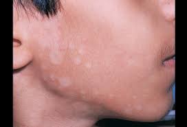 White spots on legs and white spots on your arms are also called idiopathic guttate hypomelanosis. White Spots From Sun Exposure What They Are And How To Treat Them Wcbd News 2