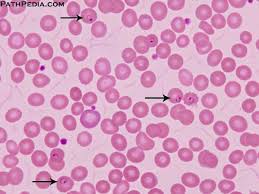 Plasmodium falciparum is a unicellular protozoan parasite of humans, and the deadliest species of plasmodium that causes malaria in humans. Histopathology Images Of Malaria By Pathpedia Com Pathology E Atlas