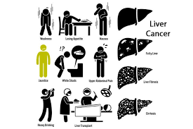 Symptoms of liver metastasis there may be no symptoms in the early stages of liver metastasis. Liver Cancer Symptoms Diagnosis Treatments