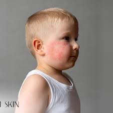 Image result for sweat rash on back baby