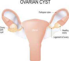 Cysts Occur Commonly In Numerous Tissues And Organs And Are Often Named According To Their Particular Anatomic Location For Example Cysts Ovarian Cyst Ovarian