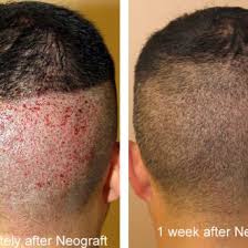 Stem cell therapy for hair loss is a relatively new method of treatment. 8 Hair Loss Ideas Hair Loss Hair Prp Hair