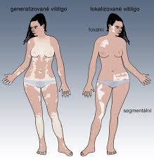 Image result for robert zaruba vitiligo