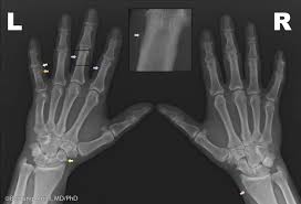 Pin On Dish Diffuse Idiopathic Skeletal Hyperostosis