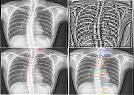 What organ is behind your right lower rib and cup hood : Evaluation Of A Computer Aided Method For Measuring The Cobb Angle On Chest X Rays Springerlink