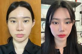 Korean Plastic Surgery Trends for Different Age Groups | AB Plastic Surgery Korea