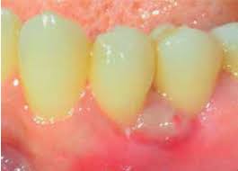 Image result for granuloma gum disease