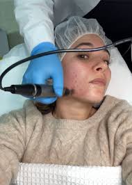 Does micropen help with uneven skin texture. Does Dermapen Skin Needling Work We Review The Anti Ageing Treatment Beauty Crew