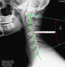 Here's what to expect with this painless procedure and why your dentist may recommend it. Guided Mark Up Cervical Spine Measurements Metron Imaging