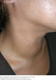 Graves' disease, also known as toxic diffuse goiter, is an autoimmune disease that affects the thyroid. Graves Disease And Goiter Basicmedical Key