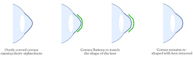 Ortho K Corneal Reshaping Innovative Eye Care