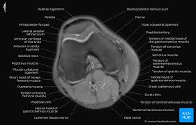 Quadriceps tendon semitendinosus tendonsemimembranosus muscle popliteal artery and vein biceps femoris femur vastus medialis sartorius muscle suprapatellar bursa. How To Read The Normal Knee Mri Kenhub