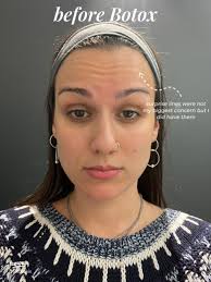 My Botox Journey: Stunning Before & After Results