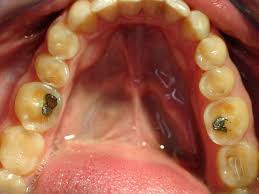 Zahne Knirschen Denta Beaute