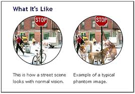 What S Charles Bonnet Syndrome Got To Do With It Blind John Movie