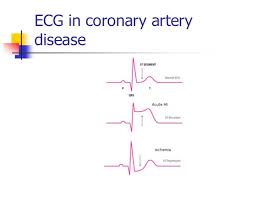 Cardiac Cycle Heart Sounds And Ecg