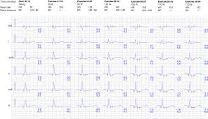 Evaluation Of Exercise Stress Test Ecg Symptoms Blood