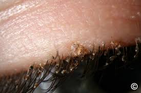 Image result for pubic lice symptoms