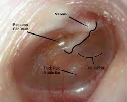 We did not find results for: Fluid In The Ear Images Mcgovern Medical School