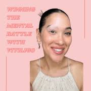 Vitiligo Model Sonya Charles