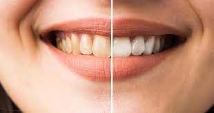 I have natural dark hair and on my ends is a few tones lighter from a previous bleaching that i did 2 years ago. Zahn Bleaching Focus Arztsuche