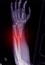 Image result for Fracture Types