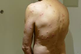 Image result for Cimex lectularius bites