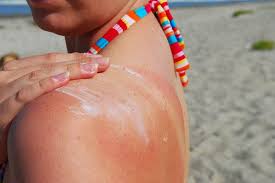 A cool bath or shower can soothe sunburn, as can a cool, damp towel or cloth (which may be your best bet on the way home from the beach). Sunburn Or Sun Poisoning Tell The Difference Upmc