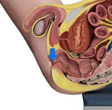Sphincter Repairs Surgery Bannerghatta Sphincteroplasty Jayanagar