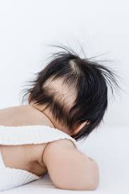 It could be a sign of a nutritional problem, such as iron deficiency, or a. Baby Losing Hair In 2020 Baby Losing Hair Baby Hair Loss Lost Hair