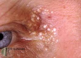 Image result for milium cyst on eyelid