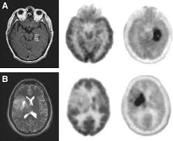 This includes a ct scan, an mri scan (considered to be superior), or both. 18f Fdopa Pet Imaging Of Brain Tumors Comparison Study With 18f Fdg Pet And Evaluation Of Diagnostic Accuracy Journal Of Nuclear Medicine