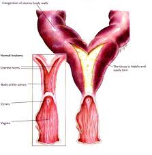 Image result for Friable Cervix