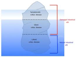 Celiac Disease From Pathophysiology To Treatment Abstract Europe Pmc