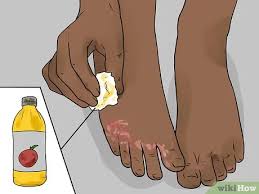 The vinegar naturally exfoliates your skin and nourishes it. 4 Ways To Use Apple Cider Vinegar For Athlete S Foot Wikihow