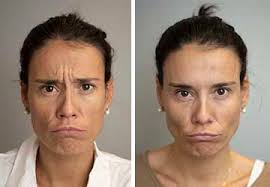 Pero una vez que haya pasado los primeros dos tratamientos, los doctores no recomiendan inyectar la toxina botulínica dos seguramente te estás preguntando en qué momento debes hacerte el tratamiento de botox en la cara. Toxina Botulinica O Botox En Barcelona Opcion Medica
