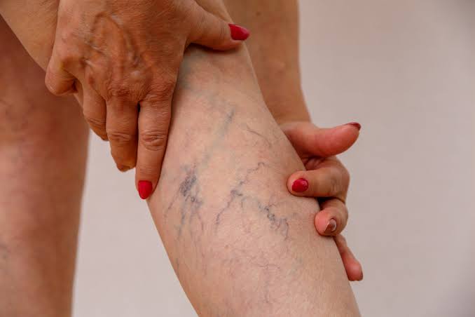 Vein Treatment in Manchester, CT | Laureen Forgione-Rubino, M.D, F.A.C.S.