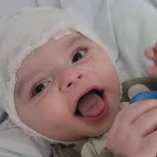 Le Bonheur Interventional Cardiologist Neil Tailor and Cardiovascular  Surgeon Umar Boston faced an obstacle. A patient with mitral valve disease  had developed a clot in a recently placed bioprosthetic valve and urgently