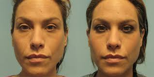 Fight the signs of aging with juvederm. Juvederm Before After Pictures Princeton And Monroe Nj