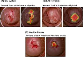 Image result for Colposcopy Findings