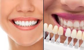 Image result for Teeth Whitening
